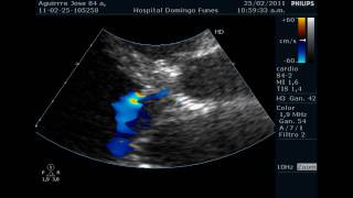 Endocarditis con Insuficiencia Aortica Aguda Dr Pedro Guillermo Bustos Febrero 2011wmv [upl. by Engud268]