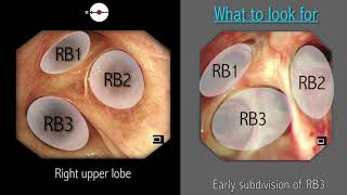 Mastering Bronchoscopy for Thoracic Surgery Chapter 2 [upl. by Enovahs]