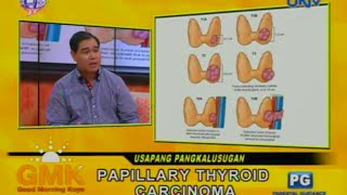 Papillary Thyroid Carcinoma [upl. by Enidlarej]