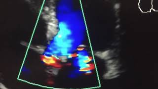 36 ECO Insuficiencia mitral con cardiopatía hipertensiva [upl. by Omora112]