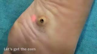 Corn Removal Laser Treatment at HLCCS RANCHI Call now  9334334935 corns callus footcare [upl. by Sirotek406]