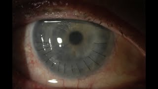 Refractive keratoplasty wedge excision in a 40 year old corneal graft [upl. by Dagall798]