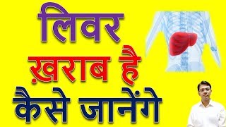 Liver Kharab Hone Ke Lakshan I Liver Damage Hone Ke Lakshan l Jondila Syrup Homeopathic [upl. by Hugo]