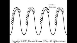 coarse crackles [upl. by Elvin]