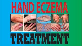 DyshidrosisDyshidrotic eczemaHand eczemaPompholyx treatment [upl. by Ossy]