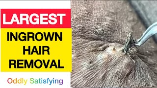 Largest Ingrown Hair Removal  Oddly Satisfying Hair Extraction [upl. by Necaj]