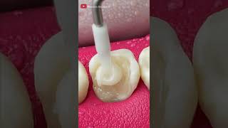 Unbelievable Tooth Restoration asmr restoration [upl. by Fredericka]