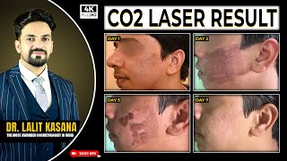 CO2 Laser Result II CO2 Laser Treatment for Acne Scars  Before After Results [upl. by Melony]