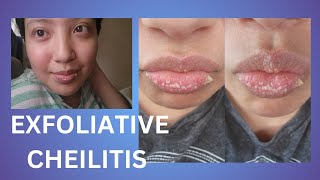 Exfoliative Cheilitis  Update [upl. by Netsoj341]