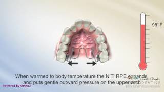 NiTi Palatal Expander  Orthodontics [upl. by Muriel]