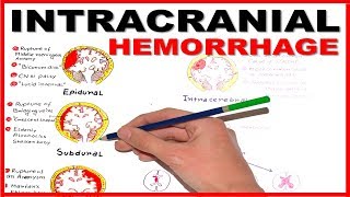 Intracranial Hemorrhage EpiduralSubduralSubarachnoid overview [upl. by Nyleimaj]