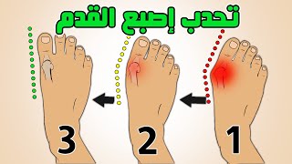 ألم اصبع القدم الكبير  علاج انحراف وتورم وخشونة عظمة ابهام القدم bunions hallux valgus [upl. by Nudd301]