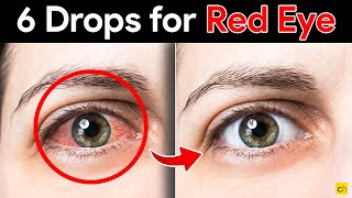 Fast and Effective 6 Eye Drops to Cure Red Eyes  Credihealth [upl. by Elleuqram]