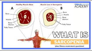 What is Sarcopenia [upl. by Olram]