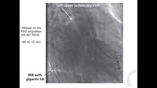 Catheter techniques 4 LV catheterization  Elias Hanna Univ Iowa [upl. by Ahsien682]