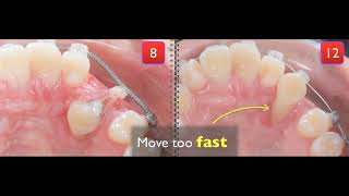 Treatment of palatal impaction [upl. by Crim55]