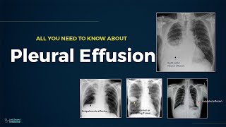 Pleural Effusion  Types Causes Evaluation amp Management All You Need To Know For Exam [upl. by Ludeman]