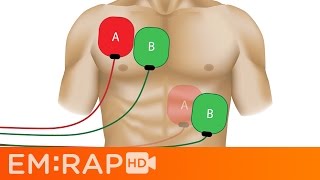 Double Sequential Defibrillation [upl. by Atival496]