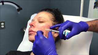 Dr Nino Kuzmar Injects Female Patient with Juvederm Volite SKIN HYDRATOR [upl. by Madai553]