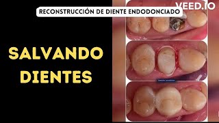 SALVANDO DIENTES Reconstrucción de Diente Endodonciado [upl. by Hannaj655]