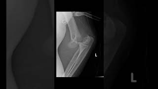 Supracondylar region fracture xray anatomy [upl. by Cochran]