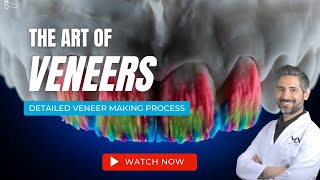 Making Porcelain Veneers  The Art of Veneers [upl. by Gilus]