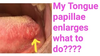 Enlarged tongue papillaeFoliate papillae enlarges whyI have enlarged tongue Papillae what to do [upl. by Graces]