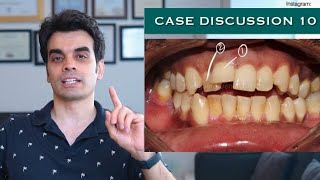 Case Discussion 10  Fixing the MalalignmentCrowding [upl. by Sharai]