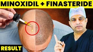 The BEST Finasteride amp Minoxidil Results 2024  Minoxidil Hair Regrowth Results  Saraswat Hospital [upl. by Llenral]