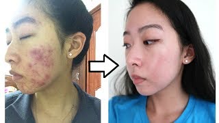 How I Cleared My Acne with ONE Product NO ACCUTANE [upl. by Aennaej]