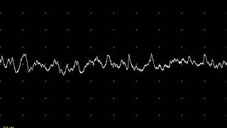 EMG teaching video 14 Endplate noise and spikes [upl. by Ion]