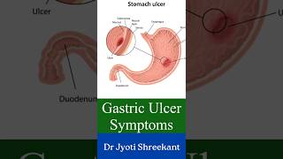 Stomach ulcer symptoms shorts [upl. by Root]