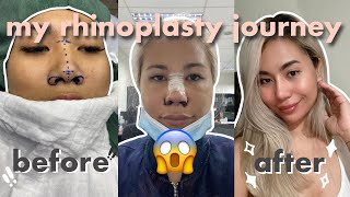 Rhinoplasty Journey  KOSMED Philippines x Alarplasty amp Nose Bridge Augmentation [upl. by Myra390]