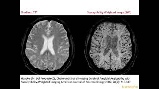 68 CAA Cerebral Amyloid micro Angiopathy vascular dementia micro bleeds superficial siderosis [upl. by Ynnig]