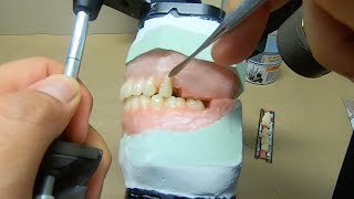 Arranging Teeth for Lingualized Occlusion [upl. by Aisatna]