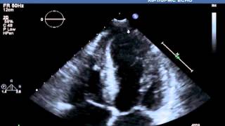 Transthoracic Echocardiographic Images Obtained after Cardiac Catheterization [upl. by Ahsiekit265]