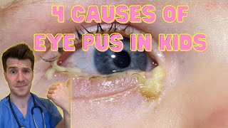 Doctor explains 4 causes of eye pus discharge or sticky eyes in kids  Doctor ODonovan [upl. by Krusche398]