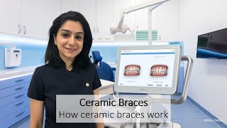 Ceramic Braces  How They Work  London  Whites Dental [upl. by Notecnirp]