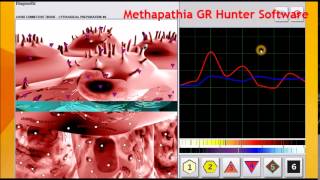 Atheromatous Aorta Medicomat Aorta Treatment [upl. by Dumanian]