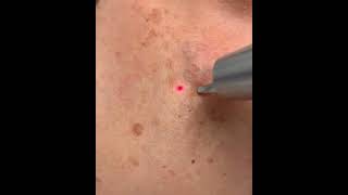 Dr Molinari  Laser Revlite  taches visage [upl. by Otis]