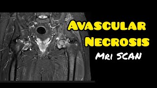 Avascular necrosis  Osteonecrosis  MRI HIP JOINT  Radiology [upl. by Suiremed]