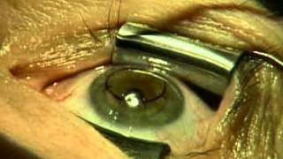 Conductive Keratoplasty CK  Jonathan Davidorf MD [upl. by Wald133]