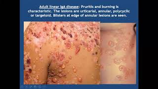 Lecture 49 Bullous Pemphigoid and related diseases PartII Rooks chapter 50 [upl. by Batha743]