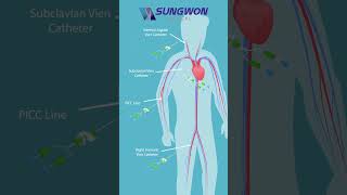 Why Is a Hemodialysis Catheter Useful with sungwon medical device OEM [upl. by Ylrebmek]