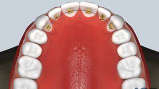 Bonded Retainer Upper [upl. by Culhert]