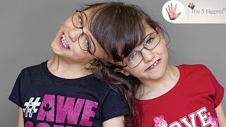 Do conjoined twins share thoughts Unbelievable facts  Body Bizarre [upl. by Cranford]