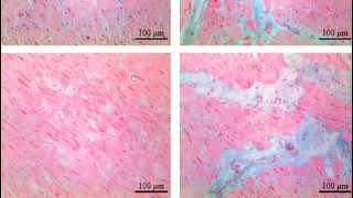 شرح محاضرة Cardiomyopathies and myocarditis  Part 2 [upl. by Yelkreb90]