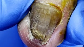 Pedicure Tutorial：Huge toenail trimming，severe onychomycosis【Pedicure Master Lin Jun】 [upl. by Buehrer921]