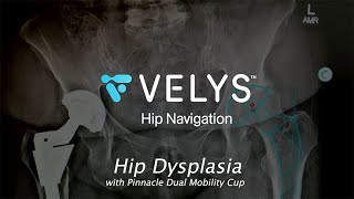 VELYS Hip Navigation with use of DEPUY PINNACLE DUAL MOBILITY LINER for Hip Dysplasia [upl. by Salangi]