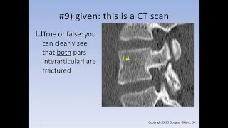 Spondylolysis  Spondylolisthesis Learning Quiz [upl. by Yttak]